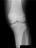 X-Ray Normal Knee Frontal View Adolescent Photographic Print