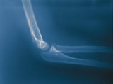 X-Ray Arm Normal Elbow Lateral View 11 Year Old Photographic Print