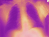 Xray Colorized Chest Normal Lungs Photographic Print