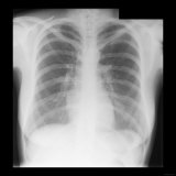 Normal Adult Chest X-Ray Lámina fotográfica
