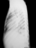 Chest X-Ray Pediatric Lateral View of Chest Photographic Print