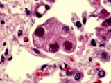 Cytomegalovirus with a Large Inclusion in the Nucleus of Lung Cells Photographic Print by Gladden Willis