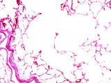 Emphysema of the Lungs, Showing Many Alveoli That Have Enlarged and Burst Photographic Print by John D. Cunningham