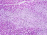 Human Myocardial (Heart or Cardiac) Muscle Atrophy Photographic Print