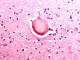 Alzheimer's Disease Lipid Granule in a Human Brain Photographic Print by George Musil