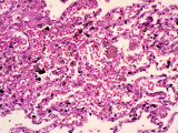 Anthrax, Bacillus Anthracis, in the Lung, Pulmonary Hemorrhage, H&E Stain Photographic Print by Frederick Skvara