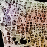 Osteoporosis from an 89 Year Old Female Fotografisk trykk av Alan Boyde