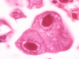 Cytomegalovirus with a Large Inclusion in the Nucleus of Lung Cells Photographic Print by Gladden Willis