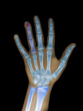 X-Ray of a Human 12 Year Old Hand and Wrist Lámina fotográfica por Barry Slaven
