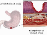 Biomedical Illustration Showing an Acute Gastric (Peptic) Ulcer Lámina fotográfica Biomedical Illustration Showing an Acute Gastric (Peptic) Ulcer Lámina fotográfica