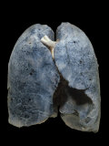 A Smoker's Damaged Lungs Photographie par Ralph Hutchings
