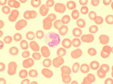 Human Blood Erythrocytes or Red Blood Cells and a Leukocyte or White Blood Cell Photographic Print by John Forsythe