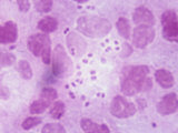 Neisseria Gonorrhoeae Bacteria in Human Tissue, the Pathogen That Causes Gonorrhea Photographic Print