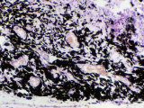 Cross-Section of Lung Tissue from a Coal Miner Showing Large Quantities of Coal Dust Photographic Print by Ralph Hutchings
