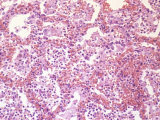 Edema of Human Lung Tissue Photographic Print by Ralph Hutchings