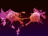 Lung Cancer, Electron Microscopy Unit, Cancer Research, UK Photographie par Anne Weston