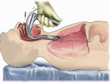 Proper Laryngoscopic Endotracheal Intubation Photographic Print