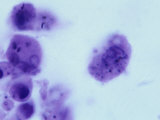 Phagocytes in the Human Lung Showing Ingested Carbon Granules in their Cytoplasm Photographic Print by Ralph Hutchings