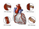 Medical Illustration of the Human Heart Showing Various Degrees of Coronary Artery Disease Photographic Print