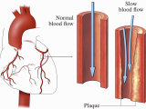 This Medical Exhibit Pictures an Anterior (Front) View of the Heart and Coronary Arteries Photographic Print