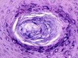 Solar Keratosis of Human Skin Photographie par Michael Abbey