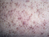 Skin of a Person with Scurvy, Caused by a Vitamin C or Ascorbic Acid Deficiency Photographic Print by Ken Greer