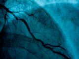Images of Coronary Arteries on a Screen at a Cardiac Lab Photographie par Todd Gipstein