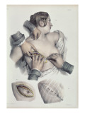 Operating on a Cancerous Tumour Reproduction procédé giclée par Nicolas Henri Jacob