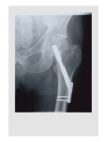 Fixed Femur Wall Decal