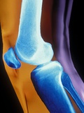 Normal Human Knee Joint and Patella - Fotografik Baskı Normal Human Knee Joint and Patella - Fotografik Baskı