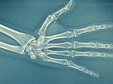 Bones of Normal Human Hand Photographic Print