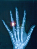 X-ray of hand with diamond ring Photographie par Thom Lang