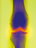 Joint X Ray Photographic Print