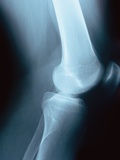 Knee Joint X-Ray Photographic Print by Robert Llewellyn
