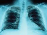 X-Ray of Dark Lungs Photographic Print by Robert Llewellyn