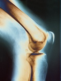 Knee X-ray Photographie
