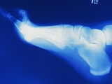 X-Ray of Person's Foot Photographie par ER Productions