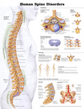 Human Spine Disorders Anatomical Chart Poster Print Posters