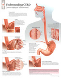 Laminated Understanding GERD Educational Disease Chart Poster Posters