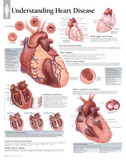 Understanding Heart Disease Educational Chart Poster Posters