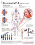 Understanding DVT Educational Disease Chart Poster Prints