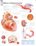 Laminated Effects of Hypertension Educational Blood Pressure Chart Poster Prints