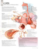 Laminated COPD Educational Disease Chart Poster Photo