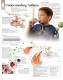 Understanding Asthma Educational Chart Poster Poster