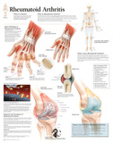 Rheumatoid Arthritis Educational Chart Poster Print