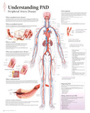 Understanding PAD Educational Disease Chart Poster Print