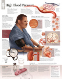 Laminated High Blood Pressure Educational Chart Poster Prints
