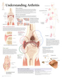 Understanding Arthritis Educational Chart Poster Posters