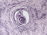Parasitic Nematode Worm in Human Skin (Onchocerca Volvulus) Photographic Print by Robert Calentine
