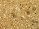 Alzheimer's Disease Brain Section Showing Both Neurofibrillary Tangles and Plaques, LM Photographic Print by Thomas Deerinck